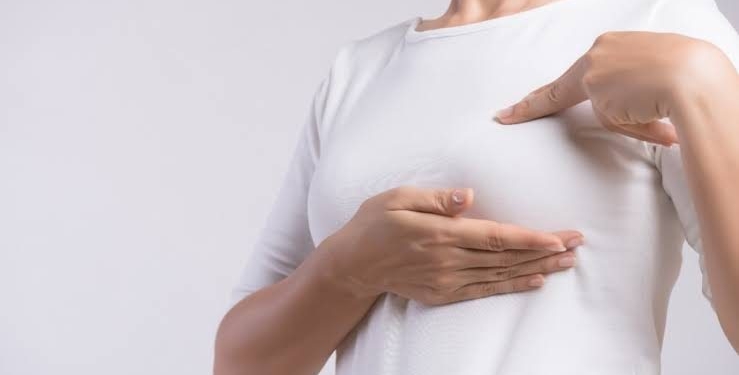 El cáncer de mama inflamatorio produce cambios en la piel en lugar de bultos, lo que dificulta su detección temprana. | Fuente: Mayo Clinic